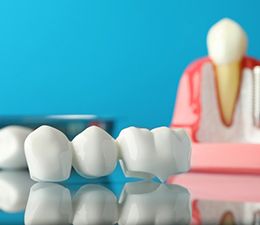 a dental bridge on a table with other tooth models