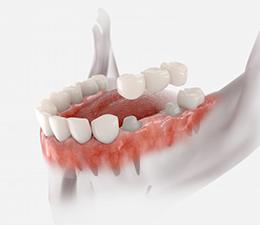 a 3D illustration of a traditional dental bridge