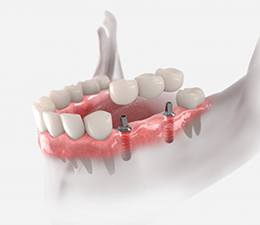 a 3D illustration of an implant bridge