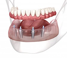 Implant dentures?