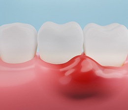 A 3D illustration of inflamed gums