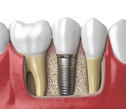 Digital illustration of a dental implant