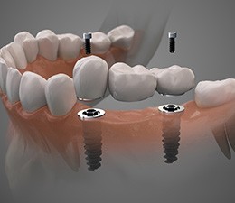 Digital illustration of a dental implant bridge