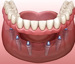 Digital illustration of implant dentures